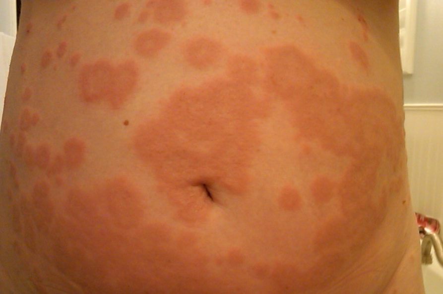It's Ella's World Now: I Can't Catch A Break PUPPS And Eye Infection - 893x593 - jpeg C Section Scar Rash