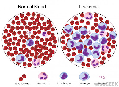 darah leukimia