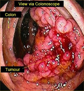 IMAGEN CANCER DE COLON imagen cancer de colon: