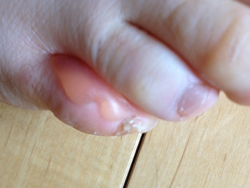 Double toe blister