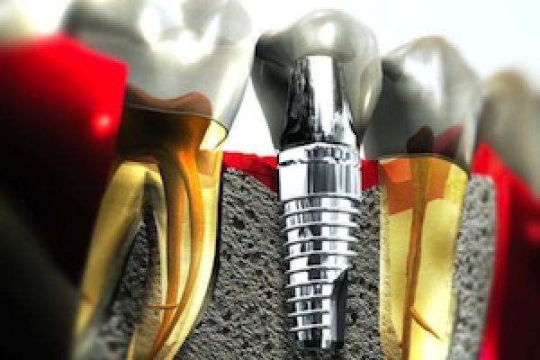 root canals, implants root canal, implant, tooth replacement, dentistry, options