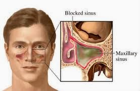 Pengobatan alami penyakit sinusitis Sinusitis+2