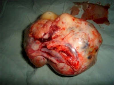 http://2.bp.blogspot.com/-1NaYZ2j6Lr0/T9X6mwEhBjI/AAAAAAAAAnA/krh3_509usw/s400/tumores_ovario2.jpg