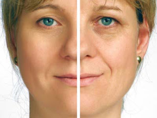 Rapid facial wrinkles