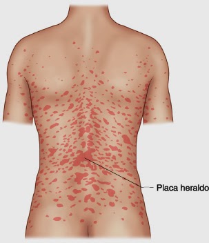 El ungüento la cera de la psoriasis las revocaciones