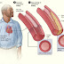 Kolesterol Punca Utama Sakit Jantung!