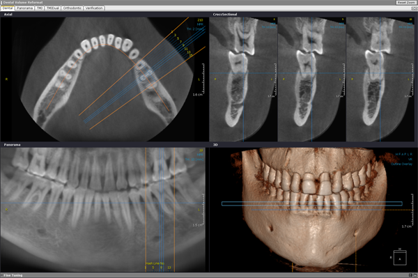 latest cone beam ct and dental Getting the full picture with cone beam dental scans dental imaging took a major leap forward at the beginning of the new millennium with a three-dimensional technology known as cone beam computed tomography (cbct). latest cone beam ct and dental Getting the full picture with cone beam dental scans dental imaging took a major leap forward at the beginning of the new millennium with a three-dimensional technology known as cone beam computed tomography (cbct).