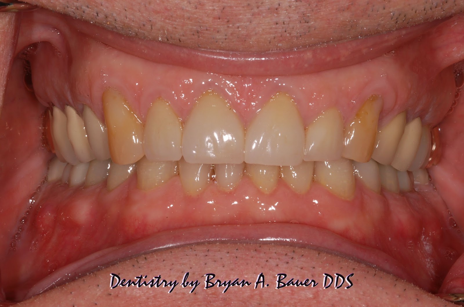 Ground down teeth? Bauer Smiles