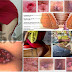 Mengempeskan Benjolan Wasir di Anus Yang Sudah Meradang thumbnail