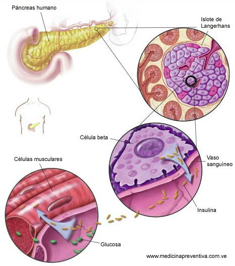 Diabetes Mellitus