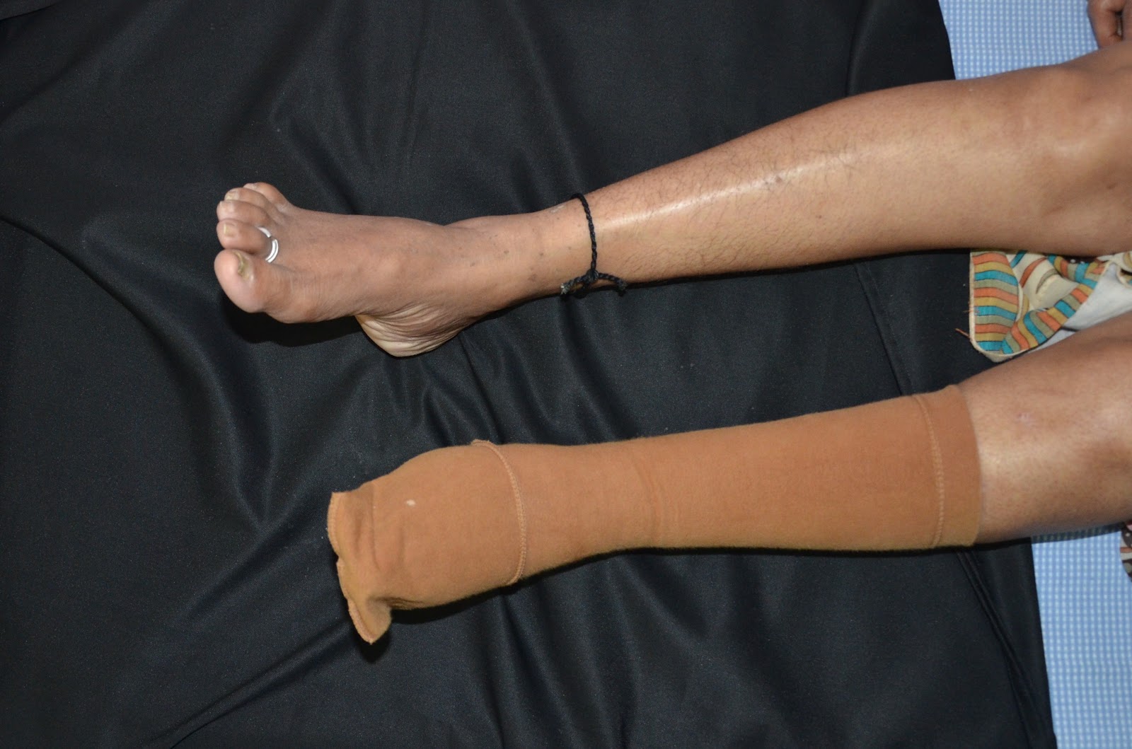 MAJOR CRUSH INJURY FOOT MICROVASCULAR FREE LATISSIMUS DORSI FLAP