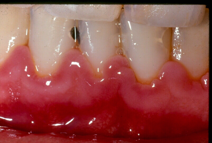 Gingivitis del embarazo Odontologia Salud y Hoy!