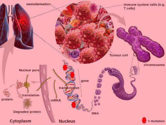 Heterogeneity of tumour / tumor mass / cancer - clinical observations demonstrate that lesions are invariably infiltrated by immune cells such as T-cells, macrophages, monocytes (lymphocytes) - Tumor-Infiltrating Leukocytes (TILs) or Tumour Associated Macrophages (TAMs) in tumour environment Heterogeneity of tumour / tumor / cancer - lesions invariably infiltrated by immune cells such as T-cells, macrophages, monocytes (lymphocytes)- tumour environment