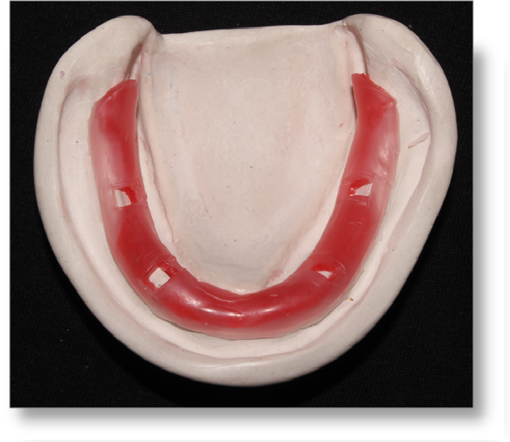 Step by step Guide for Understanding the Prosthodontics Complete