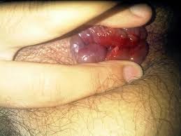wasir luar wasir luar