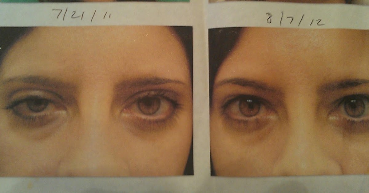 Congenital Ptosis Surgery Before &amp; After Gallery