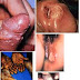 Sifilis raja singa thumbnail