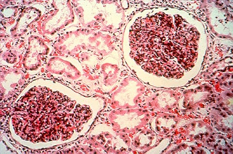 acute poststreptococcal glomerulonephritis nephritic syndrome