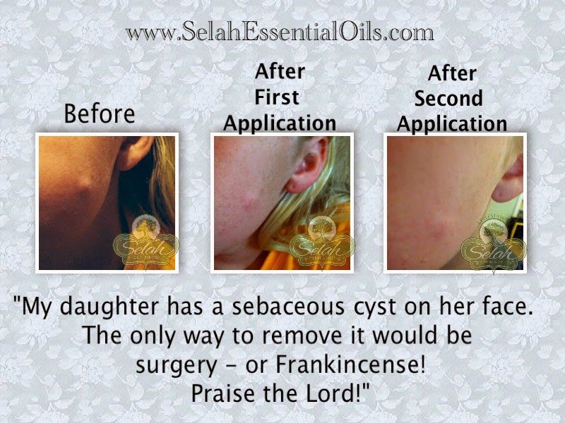 Selah's Oily Blessings Cyst and Frankincense Essential Oil