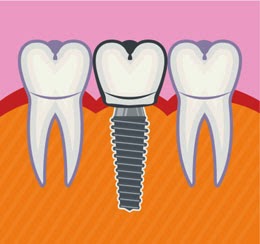 Mini implants dentaires Vs. Implants dentaires traditionnels