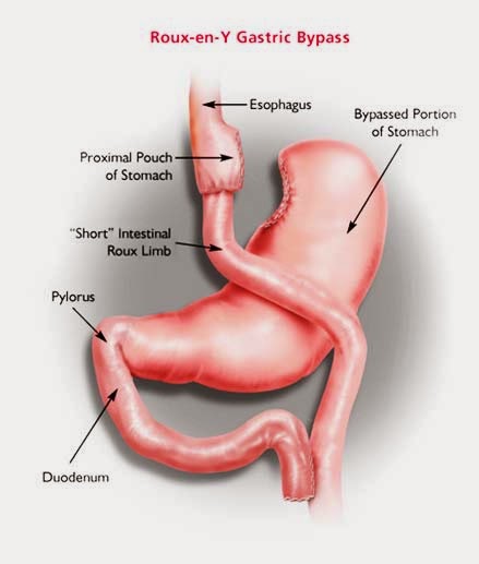 Cirurgia Bypass não retira nada