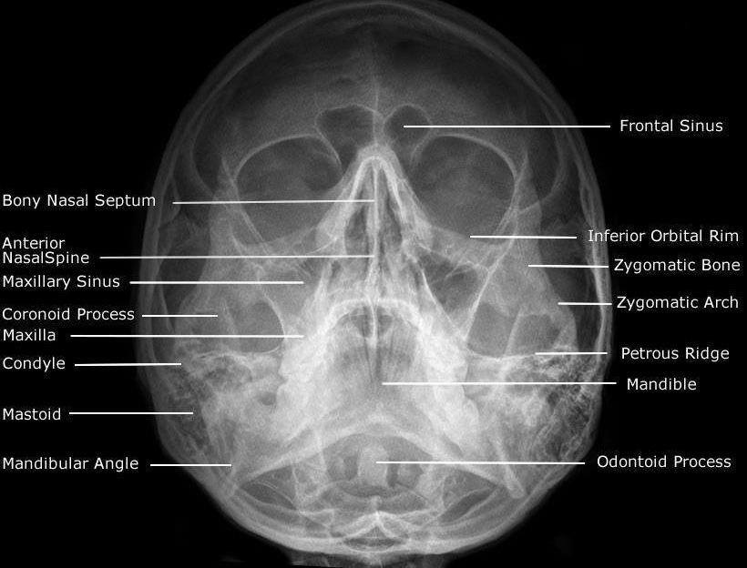 X Ray Sinus Infection