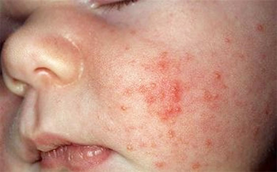 egzama tedavisi blogger