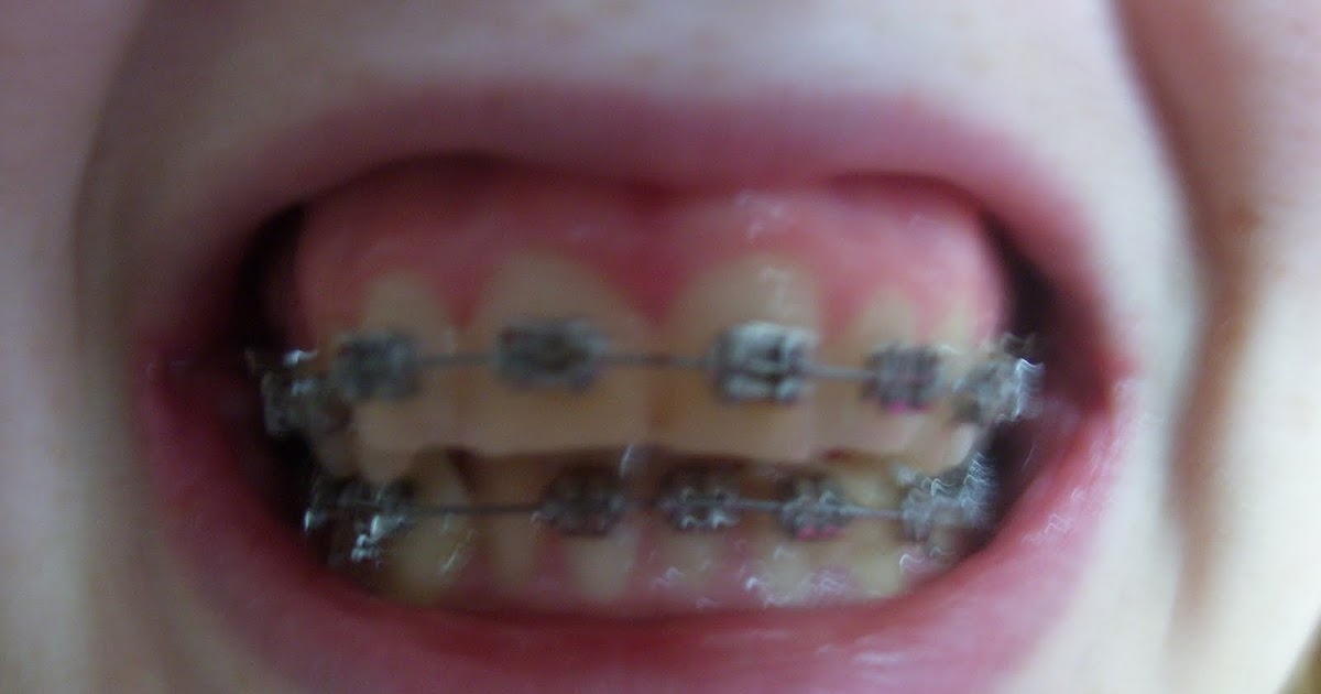 My Jaw Surgery Story Braces at last!!!