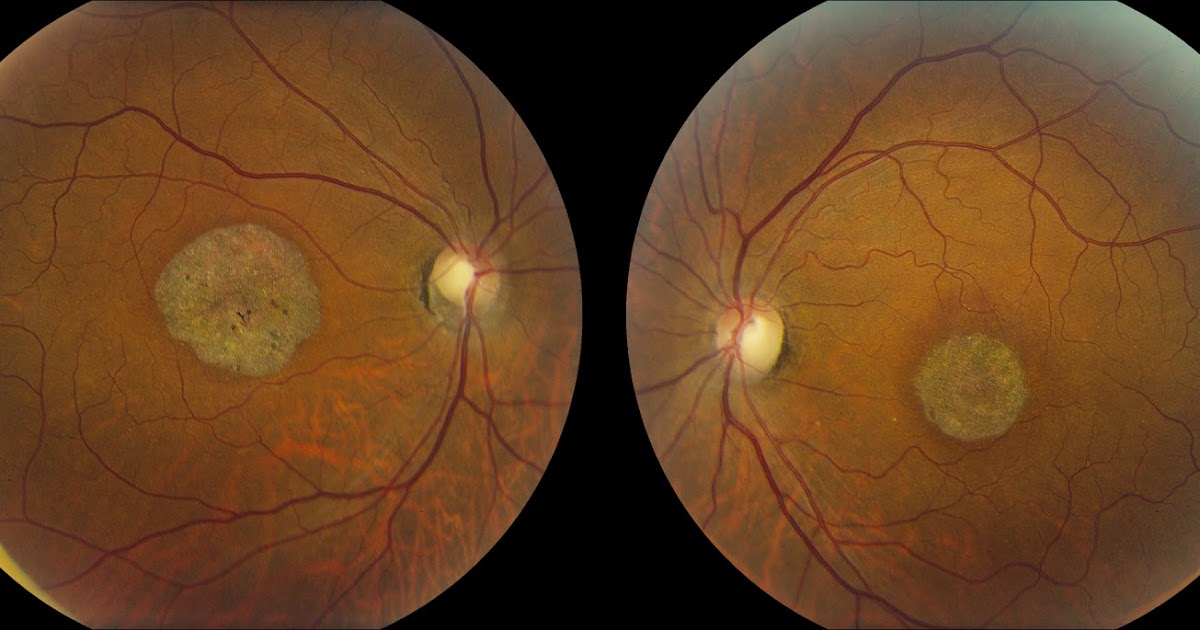 Whitman Images Cone Dystrophy