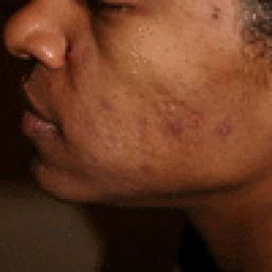 HOME TREATMENT FOR ACNE home treatment for acne: