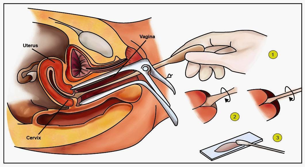 obat tumor serviks stadium 1, obat kanker serviks, pengobatan alami tumor serviks