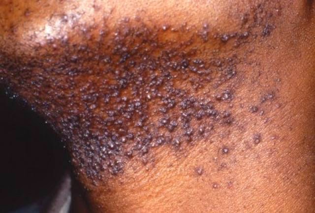 How to get rid of Shaving Bumps Fast How to get rid of Shaving Bumps Fast