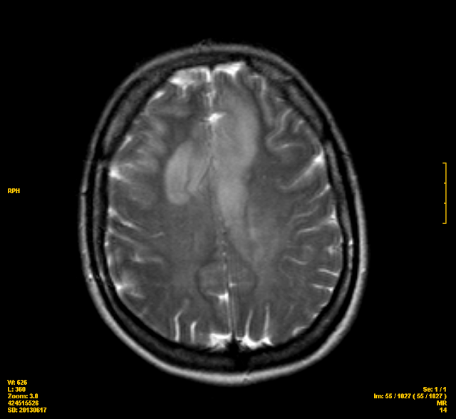 El Blog de Isa y Juan Un posible caso de Gliomatosis cerebri