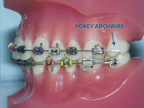 Bales Orthodontics: What should you do with a poking wire with braces?