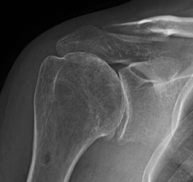 Shoulder Arthritis / Rotator Cuff Tears causes of shoulder pain