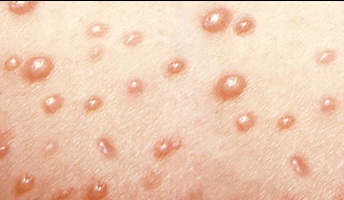 Measles as related to Chickenpox - Pictures