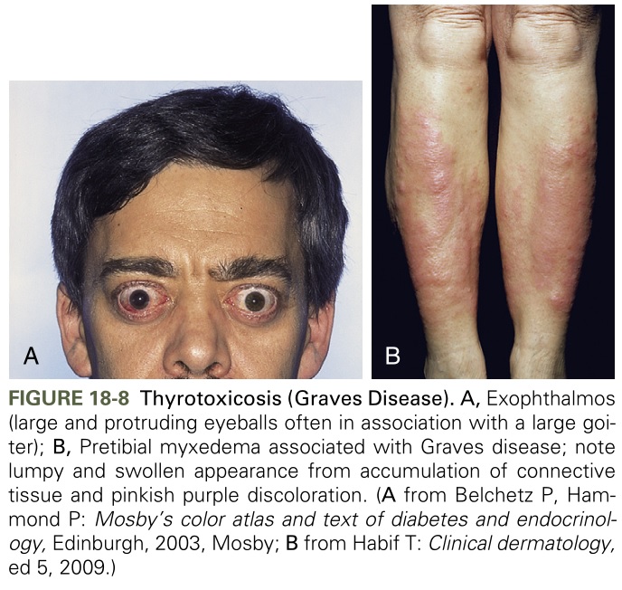 Hospital Student HYPERTHYROIDISM