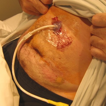 GASTROSTOMY ~ ARTICLE TROLLY