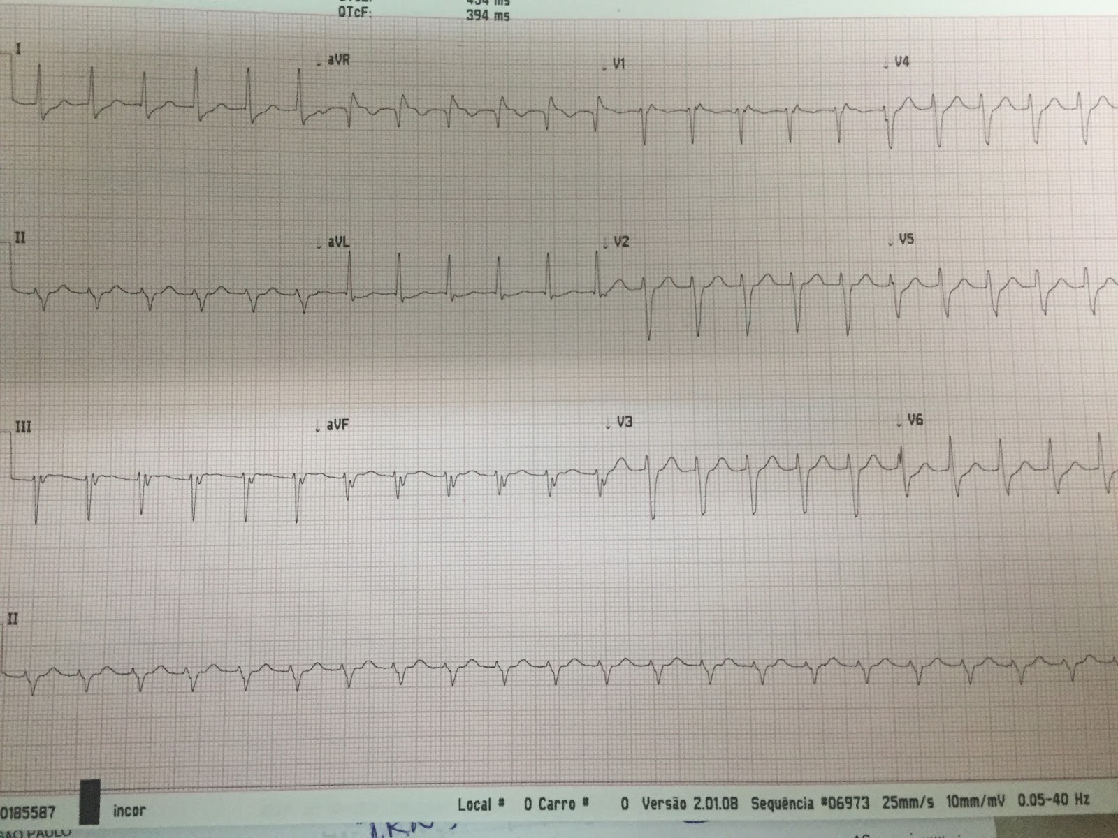 Exame ecg