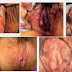 Obat Aman Sipilis Paling Manjur thumbnail