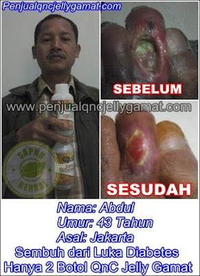 Obat Luka Gangren Tradisional Terampuh , Terbukti Manjur !! Obat Luka Gangren Tradisional Terampuh , Terbukti Manjur !!