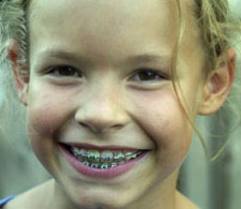 Cocuk Dis Teli Fiyatlari 2013 Cocuk Dis Teli Ucretleri Fiyati Ne Kadar