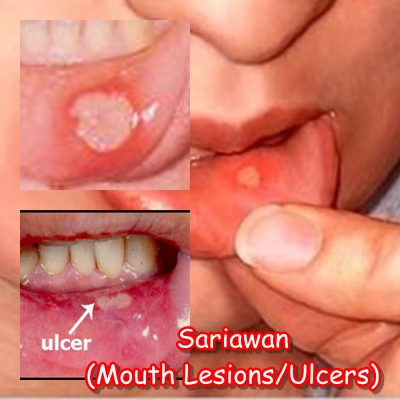 Cara Mencegah dan Mengobati Sariawan ~ Permathic Blog