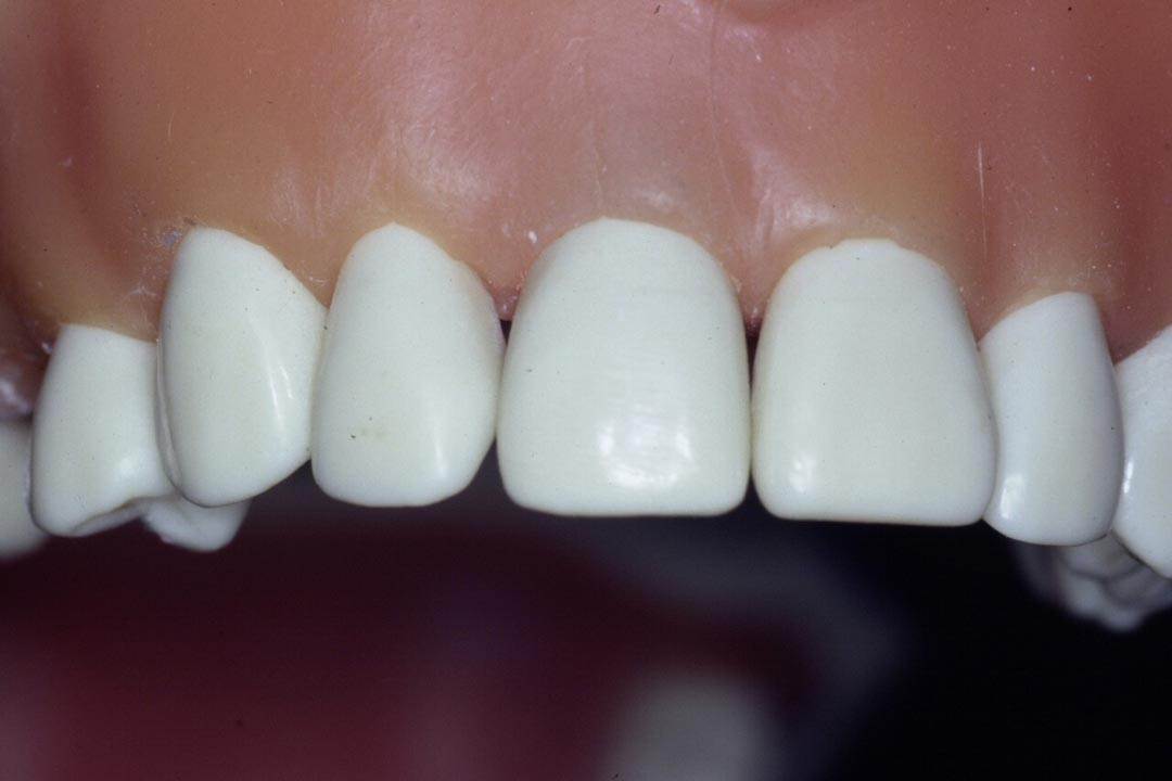 Dentistry Custom Cast Dowel Core