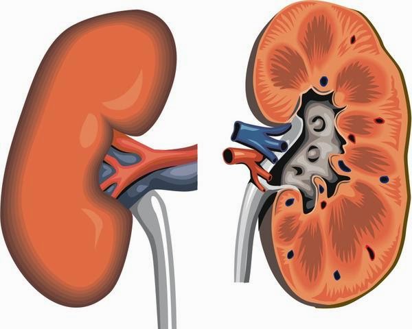 وصفات طبيعية للتخلص من حصى الكلى Dz Fashion