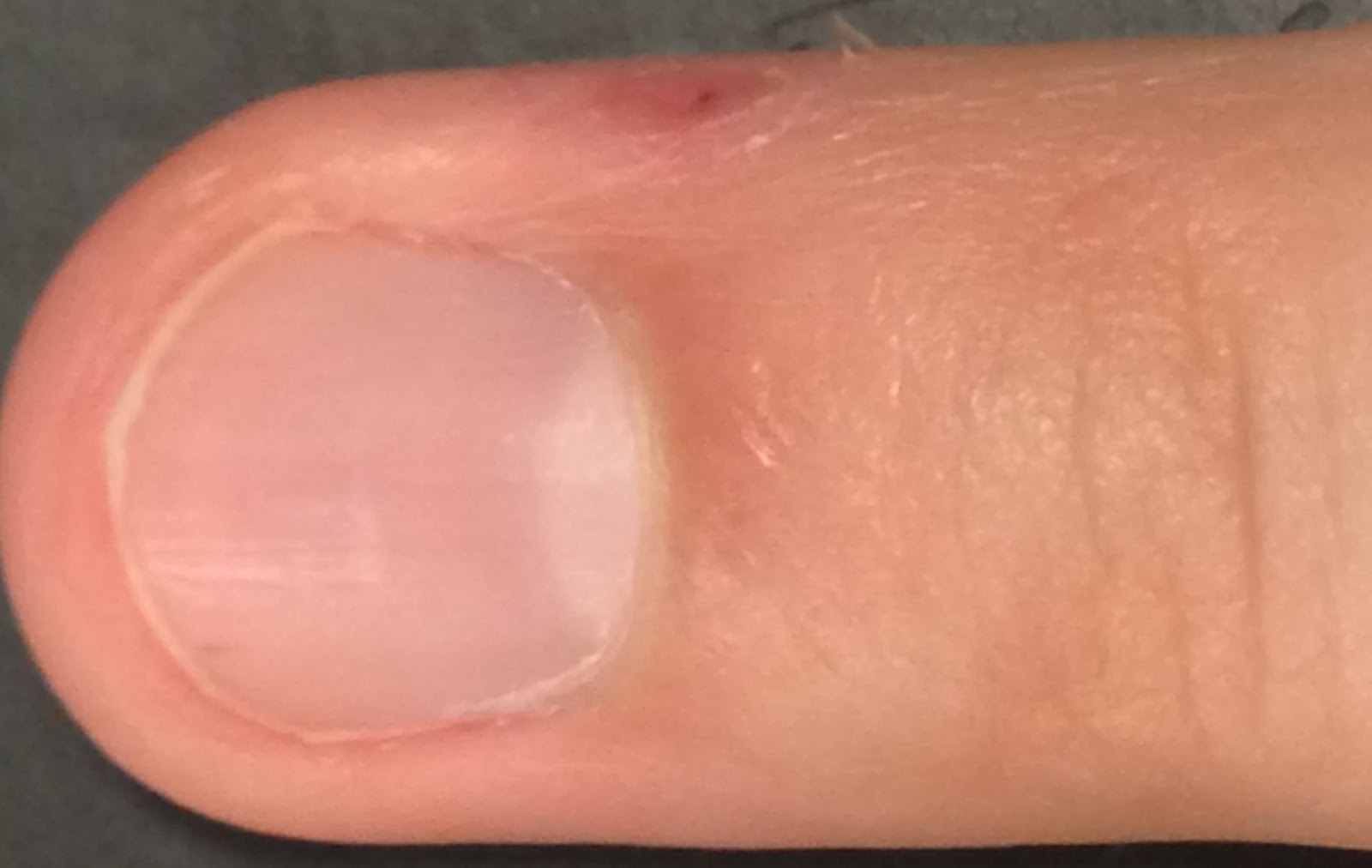 Compound W FastActing GEL Photo Review First Recovery