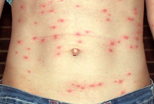 typhus fever