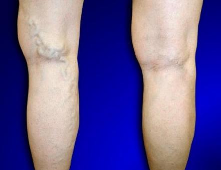 vein-location.jpg