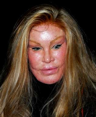 Belleza Al Dia Efectos Secundarios Del Botox