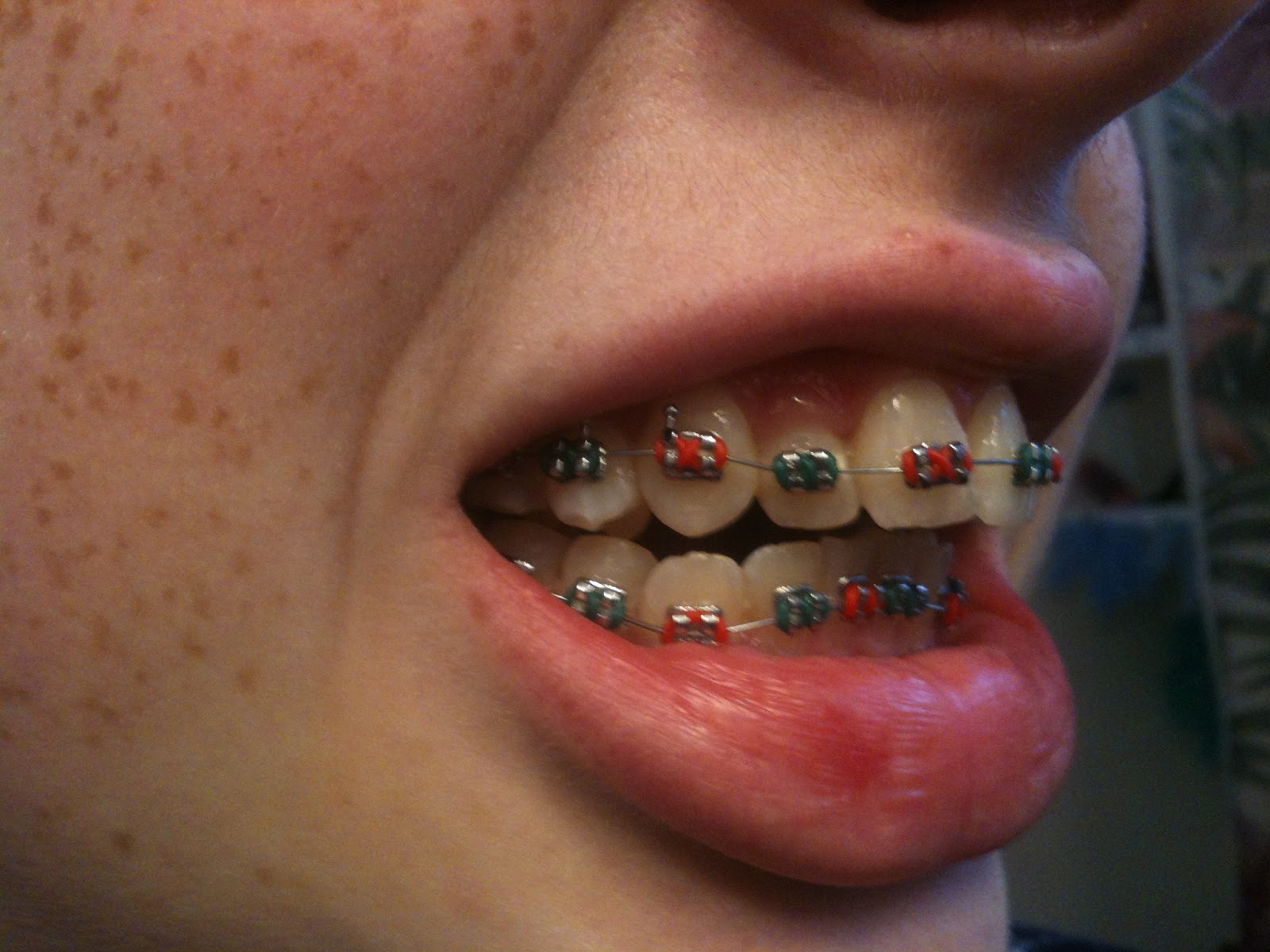 Braces Experience 6 Month Update